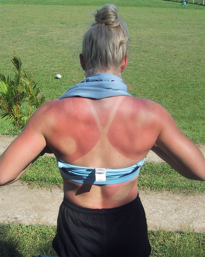 OOPS - Jen's
        sunburn